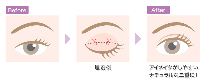 二重埋没例