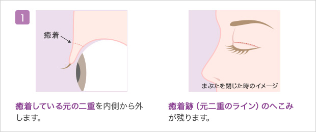 全切開二重の修正