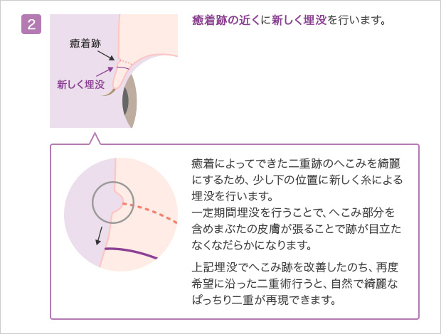 全切開二重の修正