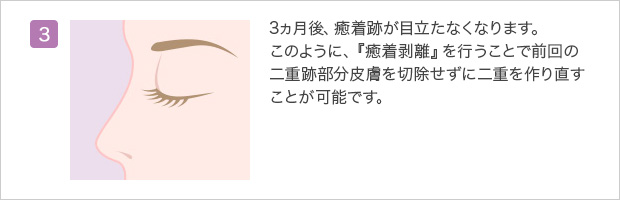 全切開二重の修正