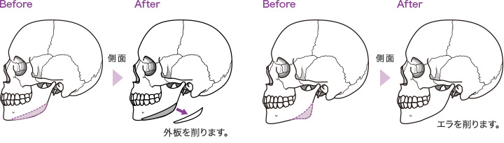 下顎角骨切り術イメージ