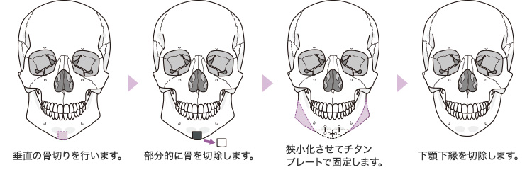 垂直骨切り法（Vシェイプ形成術）イメージ