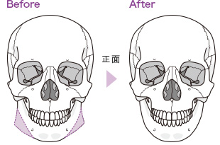 下顎下縁切除術イメージ