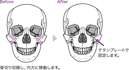 頬骨骨切り内方移動術イメージ