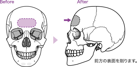 前額部形成術イメージ